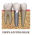Implantologie