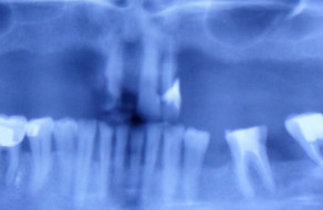 Radiografie panoramica preoperatorie