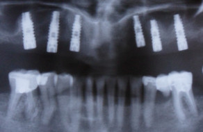 Radiografia panoramica cu implanturile inserate