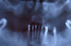 Radiografie panoramica preoperatorie