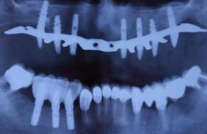 Radiografia cu implaturile inserate