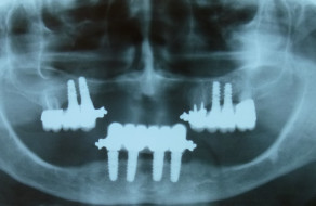 Radiografia panoramica dupa aplicarea implanturilor