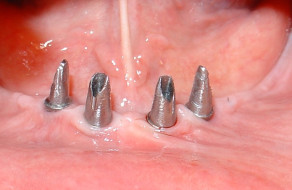 Bonturile protetice pe implanturi la mandibula